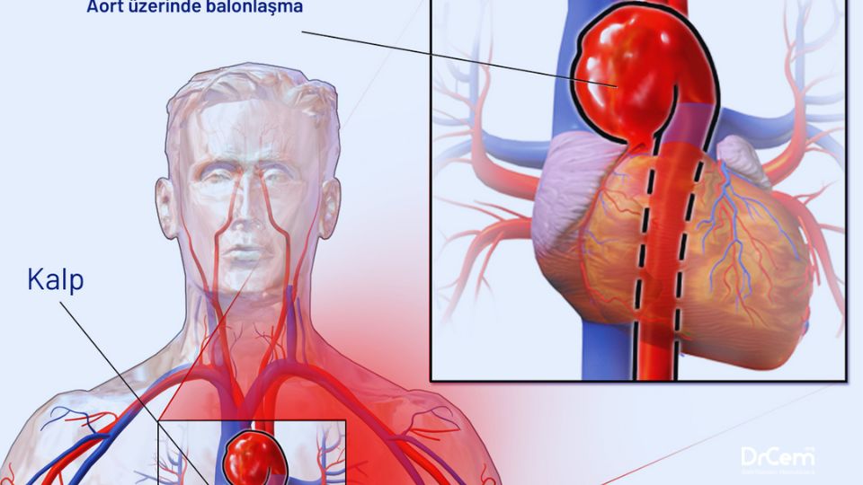Abdominal Aort Anevrizması görseli - DrCem hastalık rehberi